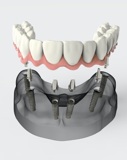 dentista portogruaro: immagine grafica di impianti dentali
