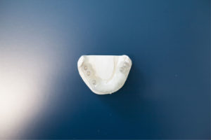 implantologia dentale computer guidata